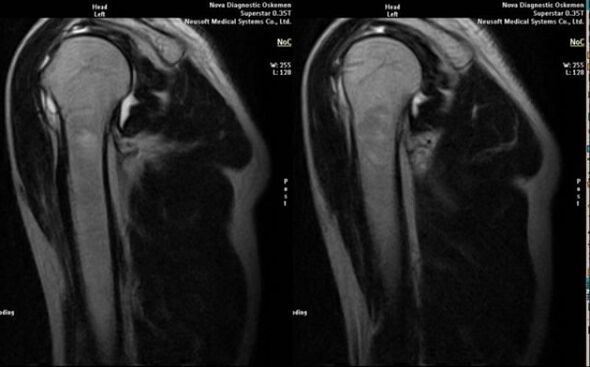 ακτινογραφία για τη διάγνωση της αρθρώσεως του ώμου