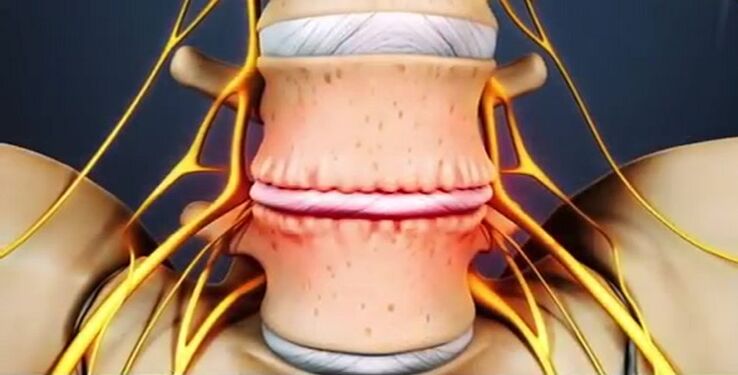 βλάβες της σπονδυλικής στήλης λόγω οστεοχονδρωσίας